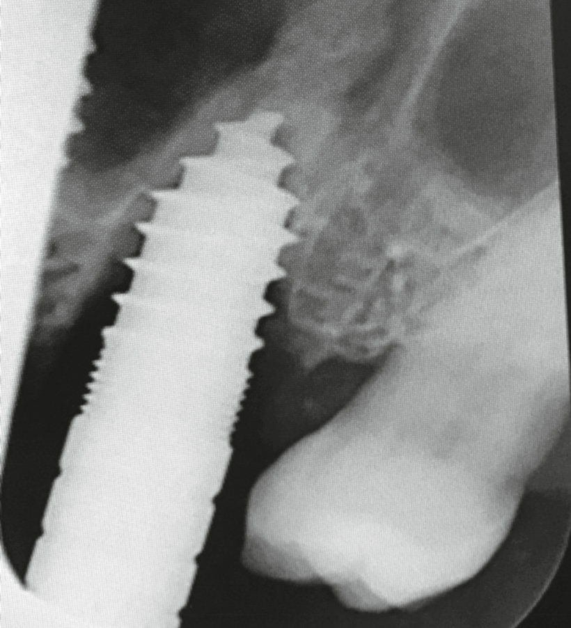 Abb. 2: Die intraoperative Messaufnahme mit Kondenser.