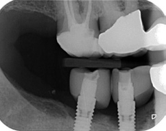 Abb. 3: Eine Periimplantitis, die durch falsche Insertion und falsches Kronendesign ausgelöst wurde.