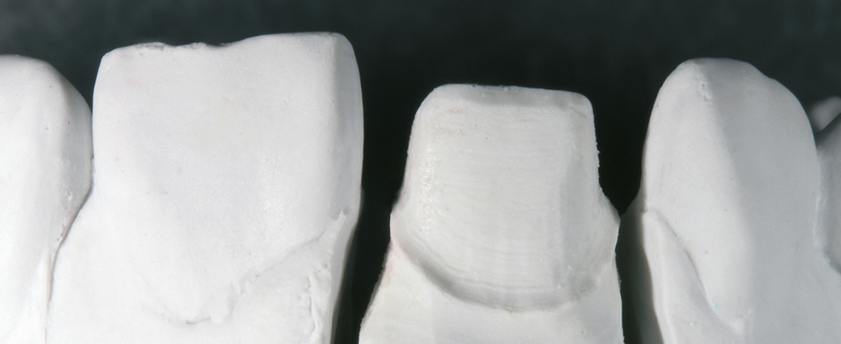 Abb. 2: Das Modell als prothetische Ausgangssituation.