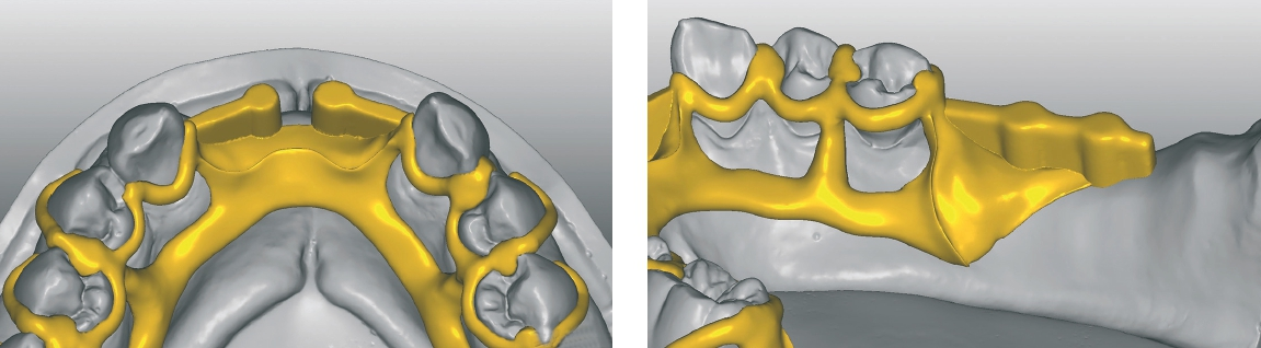 Abb. 2 u. 3: Stegartige Retentionsgestaltung mit Verbindung zum Sublingualbügel.