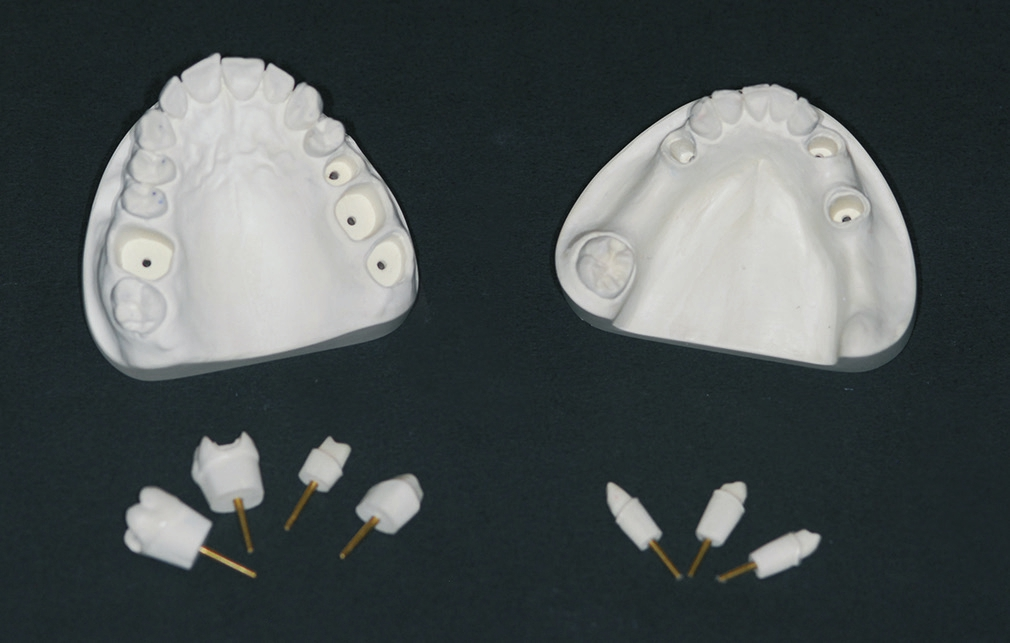 Abb. 2: Das Alveolenmodell mit den Alveolenfächern, die Stümpfe können einzeln entnommen und reponiert werden.