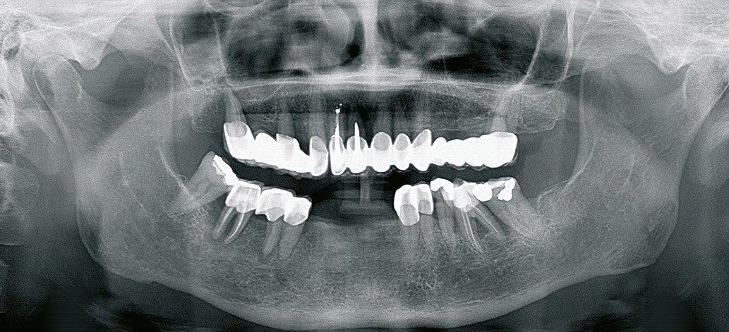 Abb. 1: Radiologische Ausgangssituation im Unterkiefer.