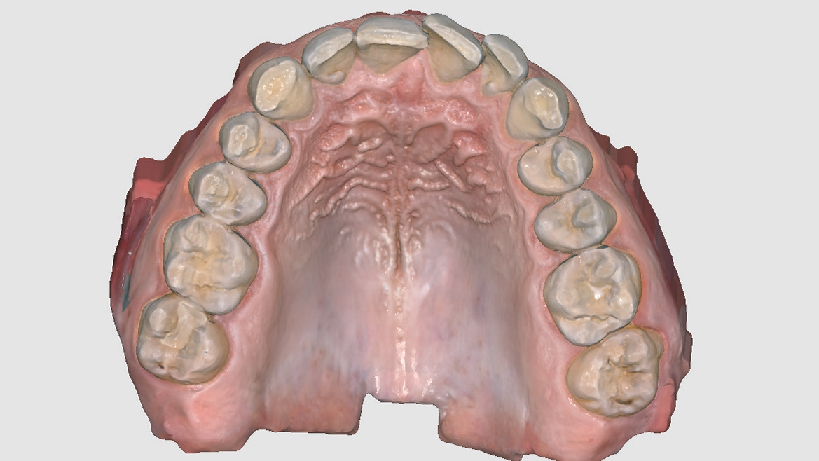Abb. 2: Oberkiefer-Intraoralscan.