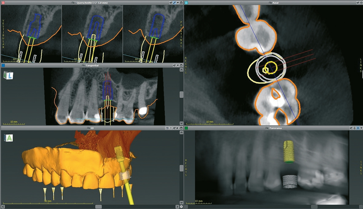 Abb. 2a: Virtuelle Platzierung eines Implantates in der CodiagnostiX-Software.