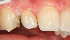 Abb. 2: Die mithilfe eines lichthärtenden Provisoriummaterials mesial an Zahn 13 fixierte Teilmatrizenfolie.