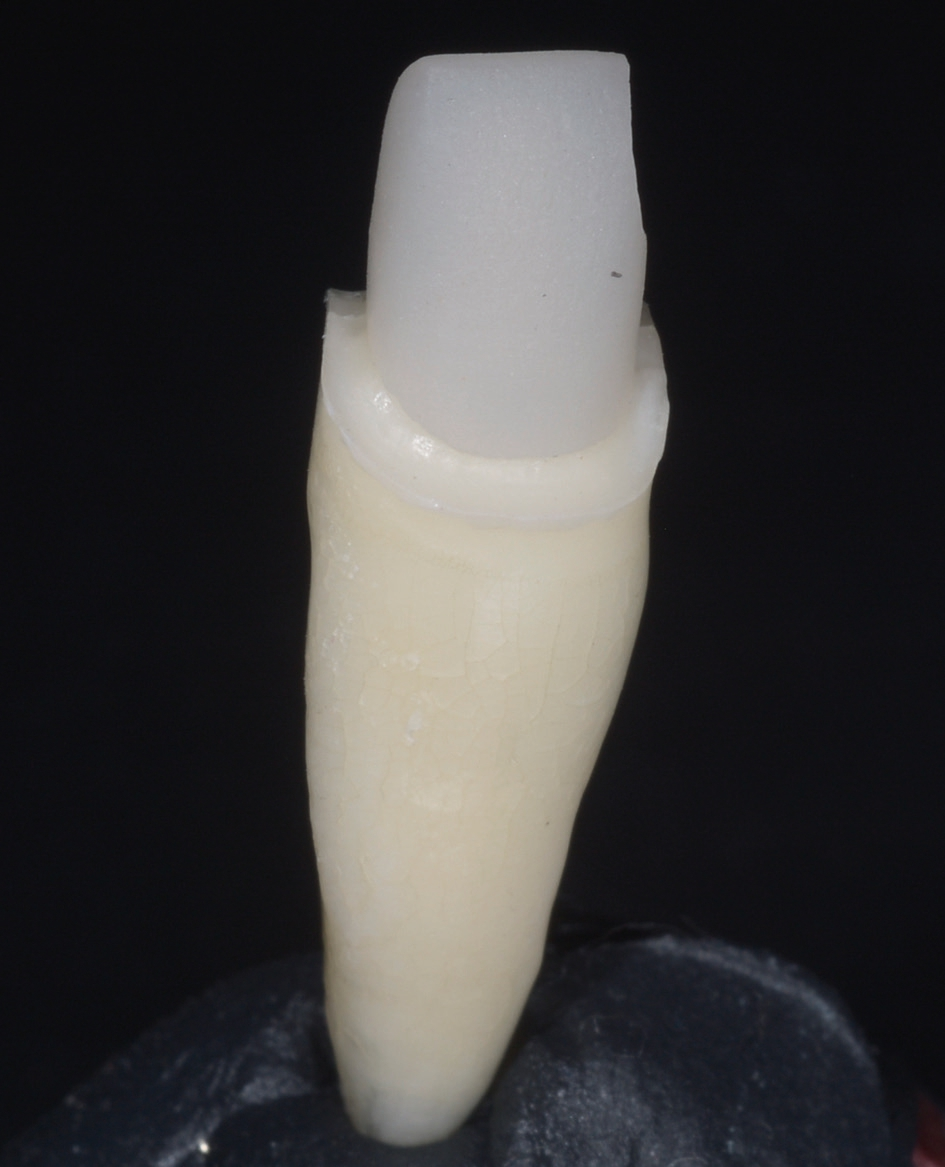 Das Verfahren kombiniert höchste Stabilität eines individuell gegossenen Metallstiftes mit einer hochästhetischen aufgepressten Keramik.