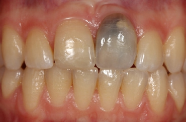 Abb. 2: Sekundärer Zahnverlust nach früherem Frontzahntrauma und interner Resorption.