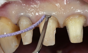 Abb. 3: Platzieren der Retraktionsschnur vor dem intraoralen Scannen mit CEREC.