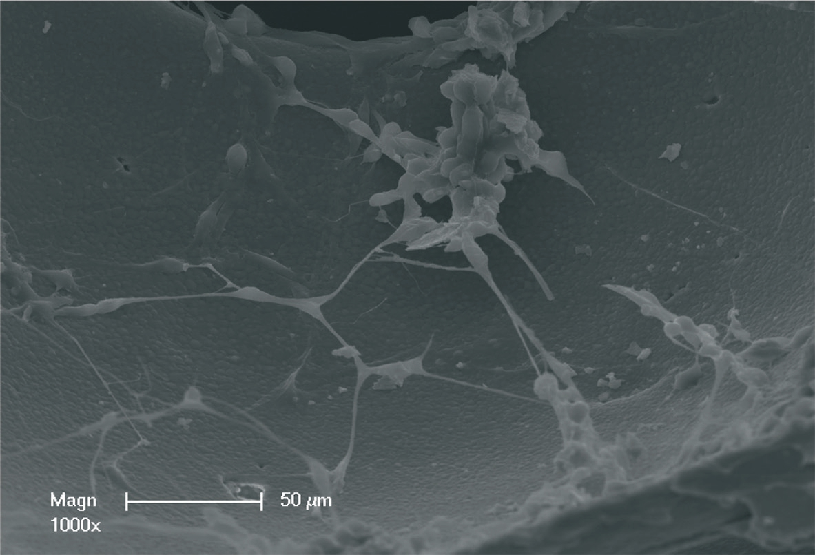 Abb. 2: Rasterelektronenmikroskopische Detailaufnahme eines synthetischen Knochenersatzmaterials auf TCP-und HA-Basis mit Zellbesiedlung. Es zeigt sich eine feinkugelige Oberfl ächenstruktur des synthetischen Knochenersatzmaterials, welches den Ausläufern der Zellkörper eine suffi ziente Oberfl ächenhaftung zu ermöglichen scheint.