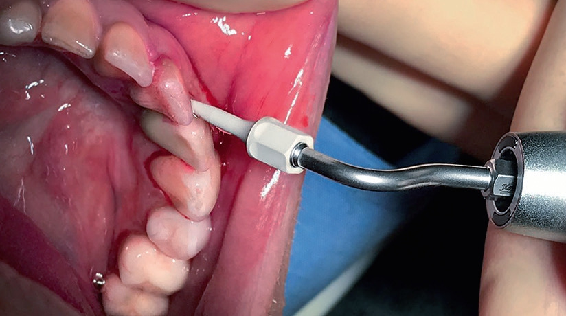 Die SF1082 gewährleistet eine abrasionsfreie Entfernung der Konkremente. Rein werkstofftechnisch kann der Polymer-Pin die Implantatoberfläche nicht beschädigen und hinterlässt eine absolut glatte Struktur.