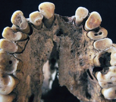 Abb. 2: Karies eines Steinzeitmenschen vor ca. 15.000 Jahren.