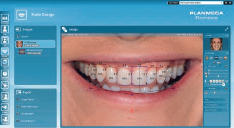Abb. 2: Nicht nur in der Patientenkommunikation ein wertvolles Tool – Planmeca Smile Design.