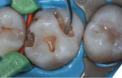 Abb. 2: Das Injectable lässt sich sehr gut applizieren. Die Vorgehensweise ist nun wie bei einer Klasse-IRestauration: Die Dentinschicht wird ebenfalls in der Farbe A2 geschichtet.