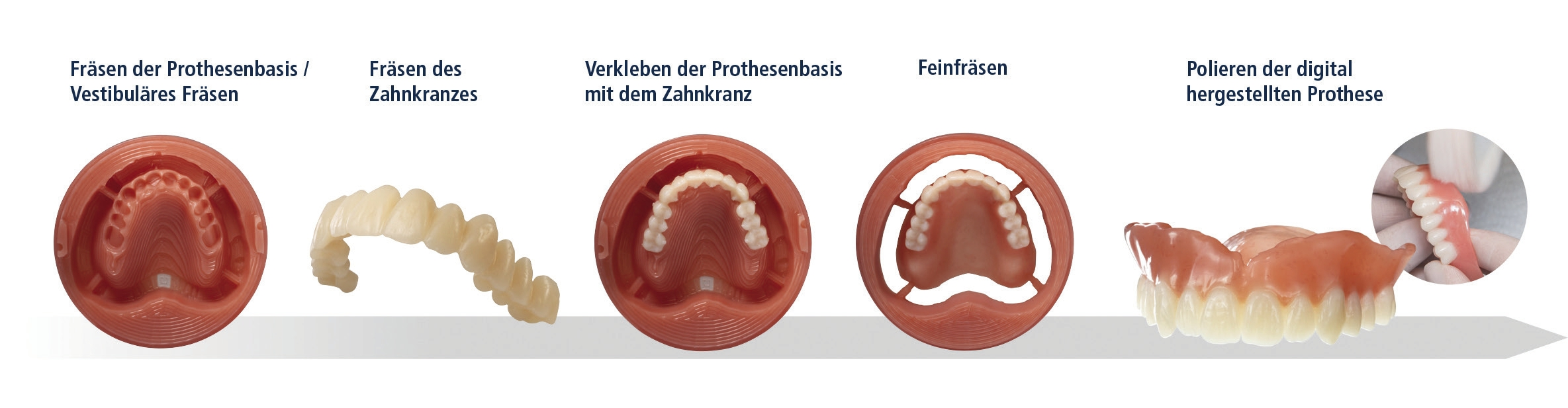Abb. 2: Ablauf des Digital Denture Systems von Ivoclar Vivadent.