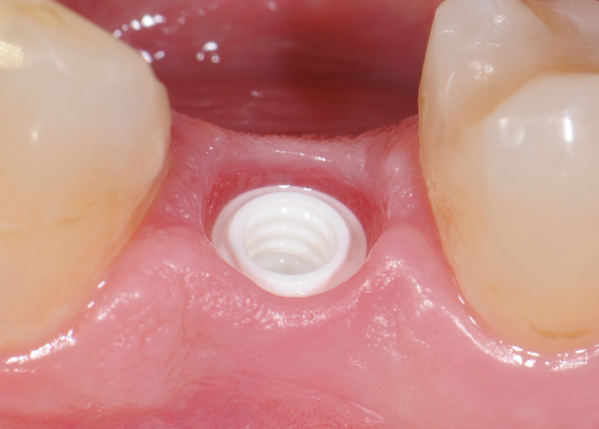 Entzündungsfreies Weichgewebe um Keramikimplantat.