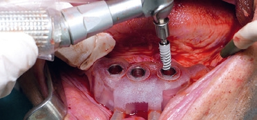 Abb. 2: Insertion eines ICX-Active Master-Implantates im Unterkiefer mit Hilfe der ICX-Magellan Bohrschablone.