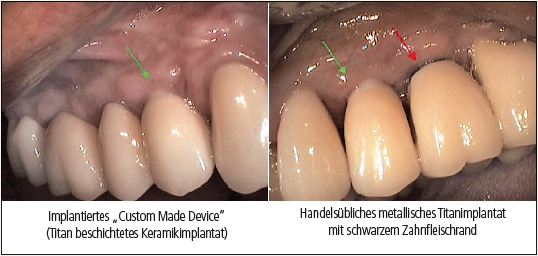 Vergleich eines mit Titan beschichteten Keramikimplantats mit einem handelsüblichen Titanimplantat.