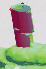 Abb. 2: Überlagerung des Intraoralscans (grün) mit dem in der CAD-Software hinterlegten Datensatz des Scanbodys (rot) zur Implantatpositionierung mittels 3-Punkt-Überlagerung.