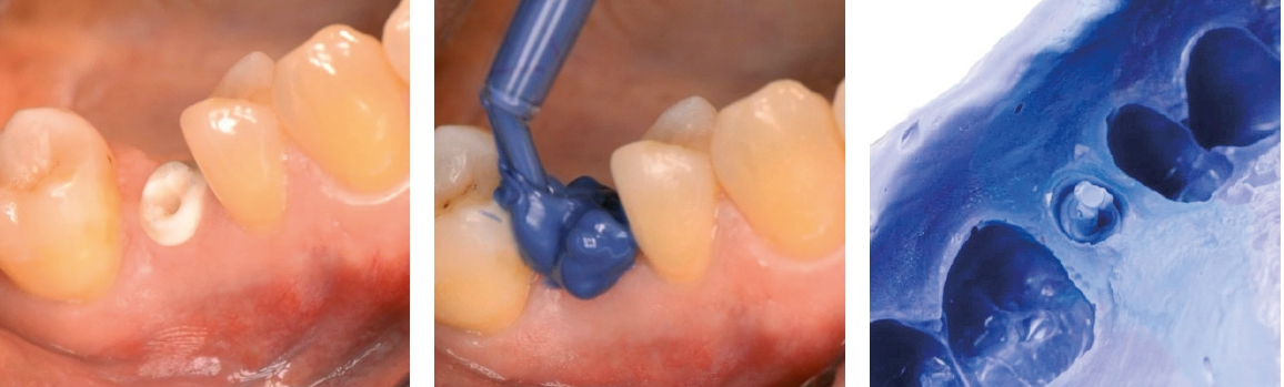 Abb. 2-4: Das BioWin! Zirkon-Implantat wird – wie bei einer Zahnpräparation – mit einem hochpräzisen Polyether- oder Silikonmaterial mit Konfektionslöffel bzw. einem Intraoral-Scanner abgeformt. Es bedarf keiner Transferpfosten, keiner Verschraubung, keines Kontrollröntgenbilds oder Verschraubung mit „offener Abformung“.