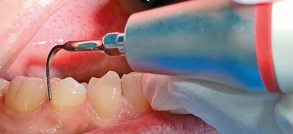 Links und rechts gebogene Ultraschallansätze bewähren sich zunehmend im supra- und subgingivalen Biofilmmanagement.