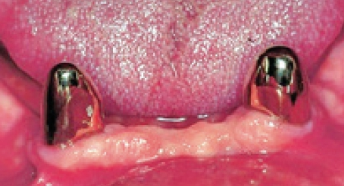 Abb. 2: Korrekte Gestaltung eines Primärteleskopes für eine Cover-Denture-Prothese: Es sind noch ausreichend hohe vertikale Führungsflächen vorhanden.