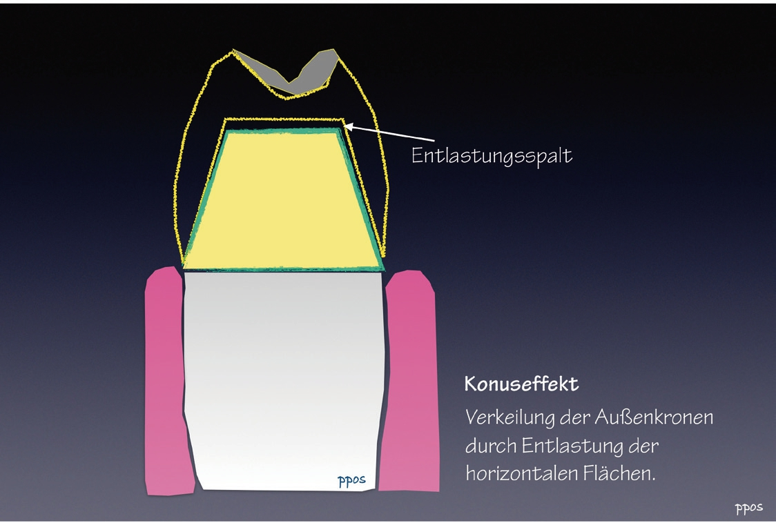 Abb. 2: Liegt eine horizontale Entlastung vor, kann sich der Konus immer setzen und festziehen.