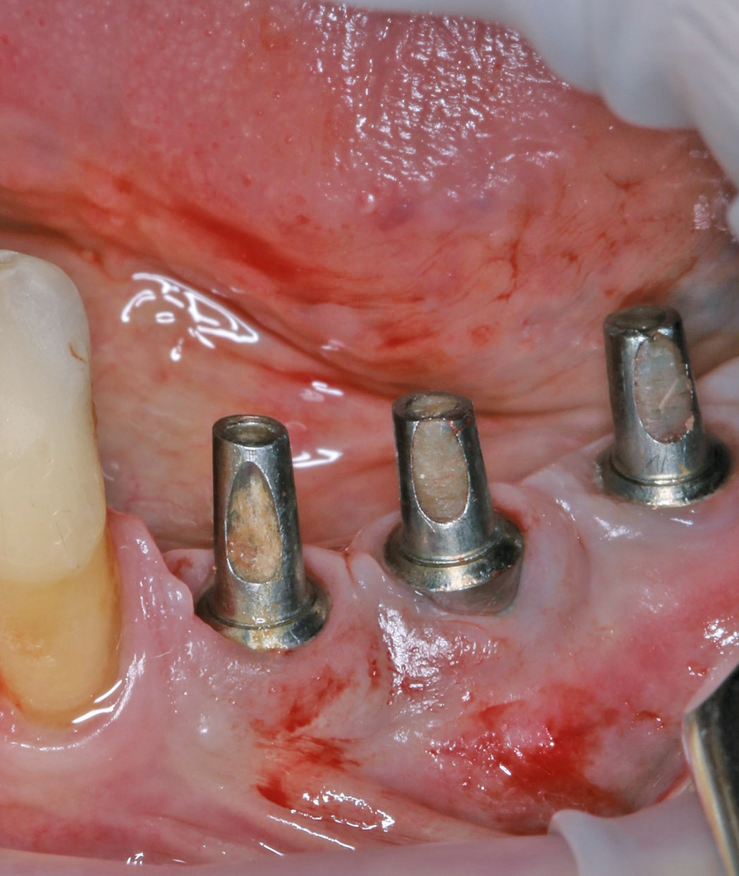 Klinisches Bild nach Periimplantitistherapie. Behandelner Zahnarzt: Dr. Dirk Heering.
