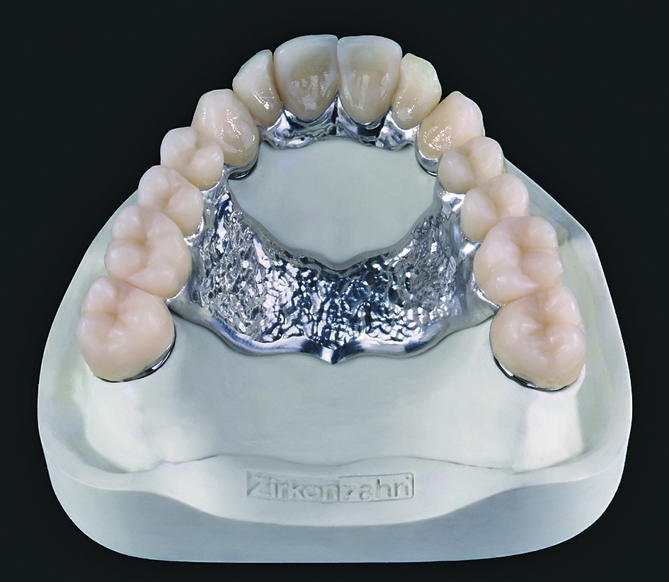 Friktive Metallteleskopversorgungen können mit dem Zirkonzahn CAD/CAM System nun auch ohne taktilen Scanner gefertigt werden.
