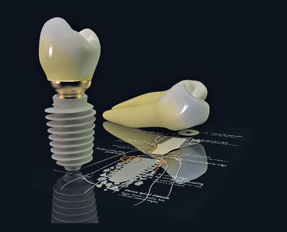 Abb. 2: AnyRidge ? das etwas andere Implantatsystem.