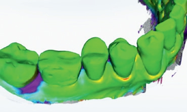 Abb. 2: Die Nachbefundung mittels 3D-Kieferaufnahme zeigt eine Gingivarezession (violett codiert), interdental regio 46/47.