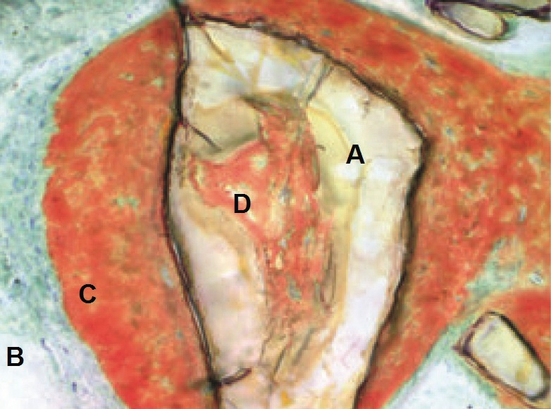 Histologischer Schnitt, nicht-demineralisiert vier Monate nach Socket Preservation: A Calcium-Phosphosilikat-Partikel, B Osteoid, C Neugebildeter Knochen mit Osteozyten, D aktive Knochenneubildung.