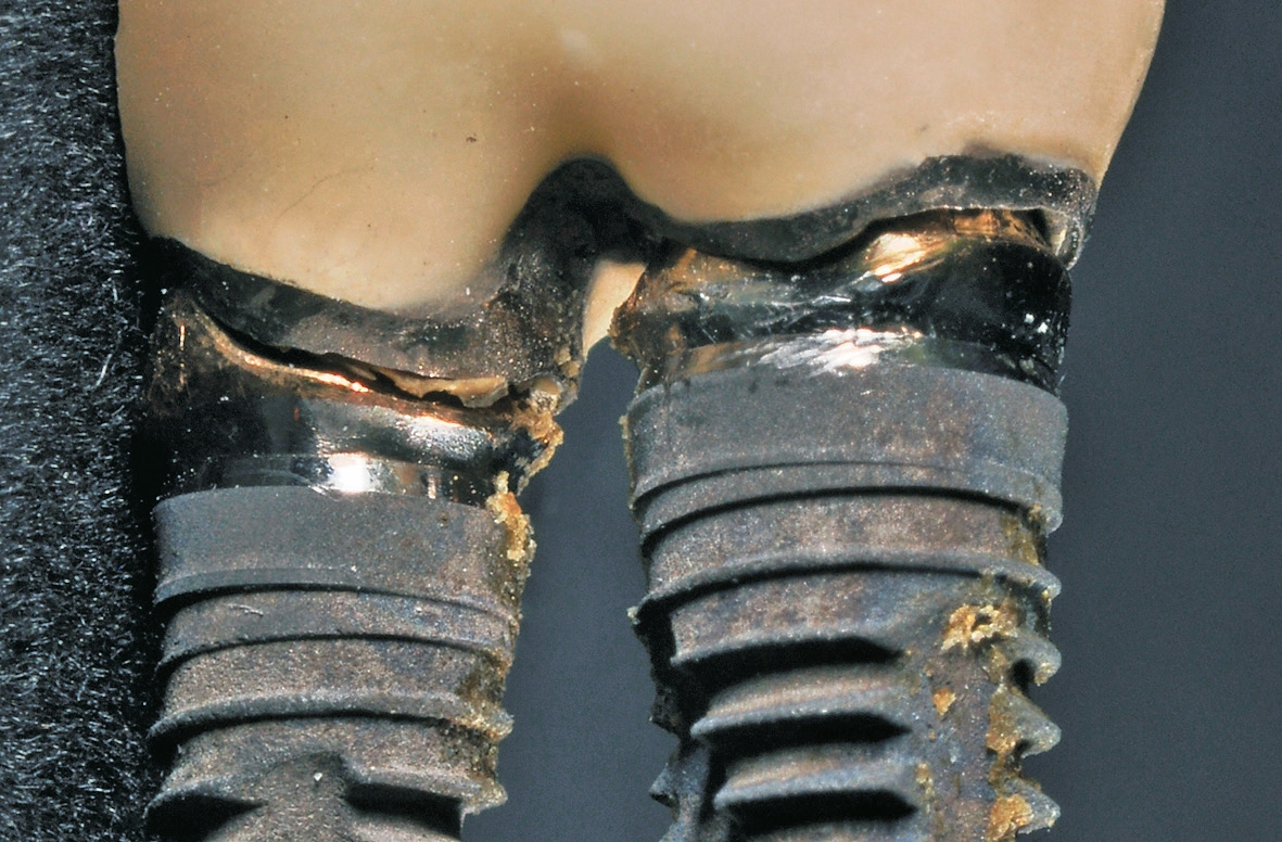 Abb. 2: Bei der Detailaufnahme eines dieser Explantate sind der fehlende Randschluss, Zementreste und die nicht reinigbare Gestaltung der Kronen deutlich zu erkennen. Außerdem sind die Implantate zu nah nebeneinander gesetzt worden – ohne Beachtung der biologischen Breite. Periimplantitis war in diesem Fall vorprogrammiert.