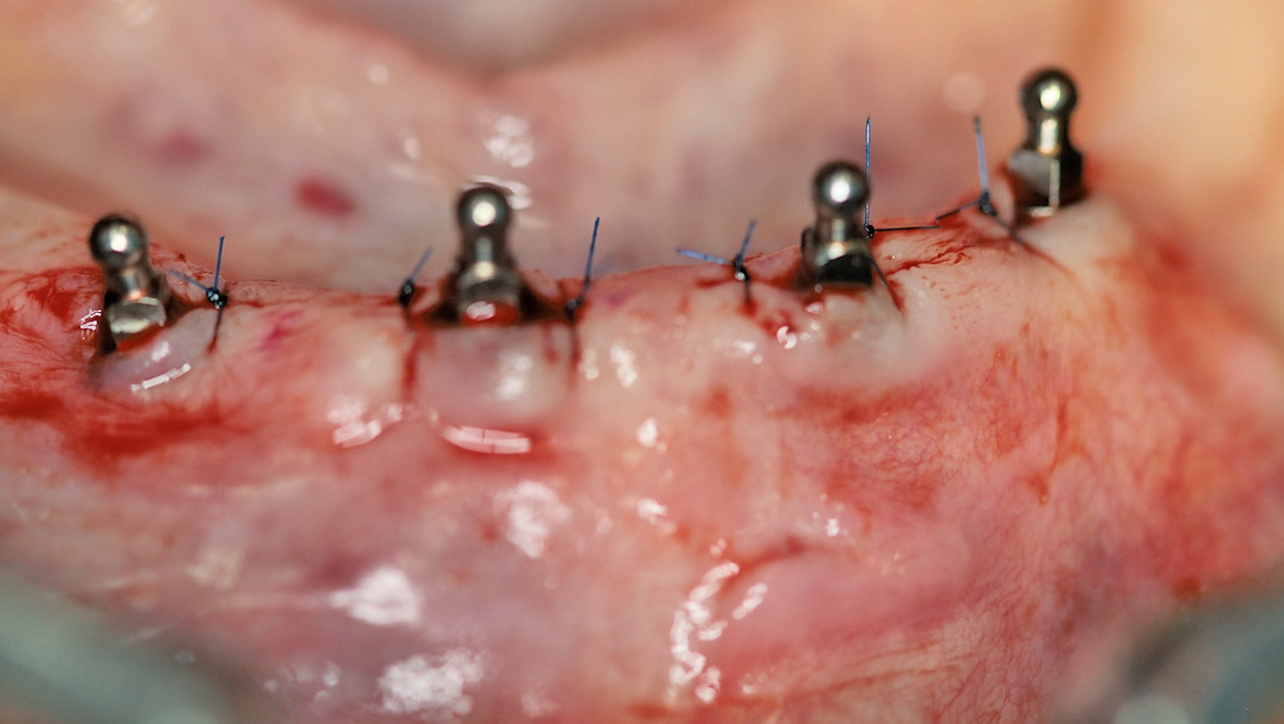 Vier Mini-Implantate in situ zur Prothesenstabilisierung, eine Stunde postoperativ.