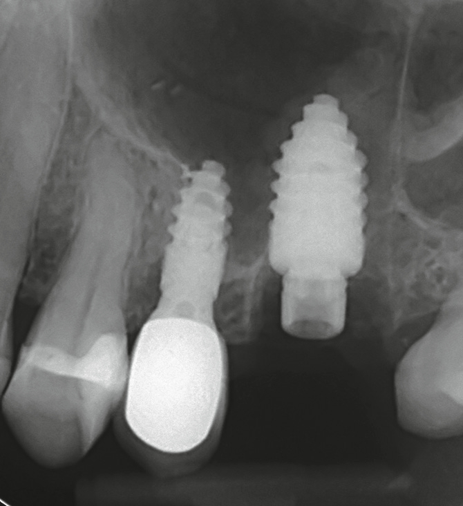 Abb. 3: Das Champions® (R)Evolution-Implantat regio 26 in situ und ohne Dentinpartikel; post implantationem.