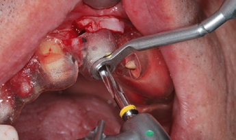 Abb. 3: Schablonengeführte Implantatinsertion.
