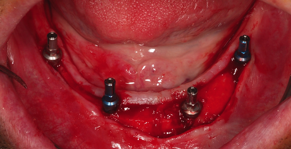 Abb. 4: Zustand nach Insertion von vier BEGO Semados® RSX Implantaten.