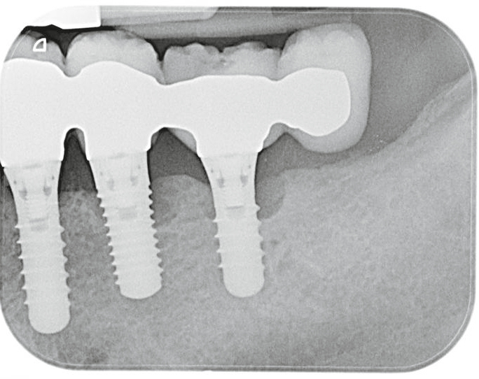 Klassisches Bild einer Periimplantitis mit kraterförmigem Knochenabbau im Bereich des Implantates.