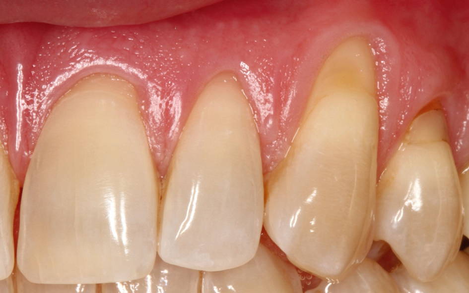 Abb. 3: Ähnliche klinische Situation an Zahn 23 wie an 13. Die Rezession reicht nicht in die bewegliche Mukosa. 1 mm keratinisierte Gingiva apikal der Rezession vorhanden.