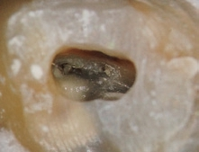 Abb. 3: Nachdem der Dentinüberhang abgetragen wurde, ist ein zweiter mesiobukkaler Wurzelkanaleingang zu erwarten.