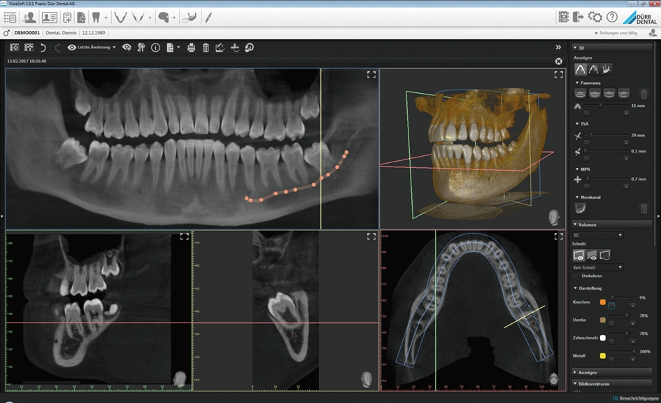 Abb. 3: Computer-Screen eines 3D-DVT aus der VistaSoft Software zusammengestellt. Besonderer Pluspunkt von VistaVox S: Jede 3D-Aufnahme generiert automatisch auch eine Panorama-Ansicht, die dank der Software VistaSoft auf dem Bildschirm angezeigt wird und die Orientierung und Übersicht über die anatomischen Strukturen nochmals erleichtert. Zu erkennen: Lage der Unterkieferweisheitszähne und Verlauf des N. mandibularis inferior (Bild: Praxis Dr. Metzger, Kirchzarten).