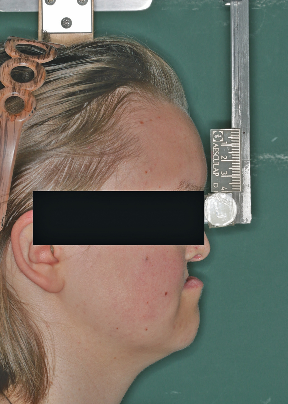 Abb. 3: Ausgangssituation vor Umstellungsosteotomie von extraoral-lateral. Deutliche Hypoplasie des Mittelgesichtes.