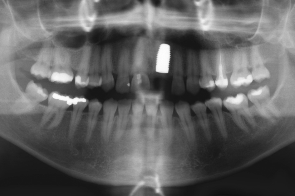 Abb. 3: OPG nach Implantation.