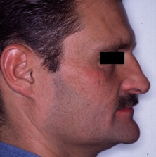Abb. 3: Konkaves Mundprofil, bei dem Kinn und Nase stärker betont sind. Die gestörte Relation in der Vertikalen ist bei diesem Patienten durch eine vertikale Unterentwicklung der Maxilla verursacht.