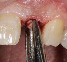 Abb. 3: Durch einen minimalinvasiven Eingriff erfolgte die Explantation des Implantats regio 22.