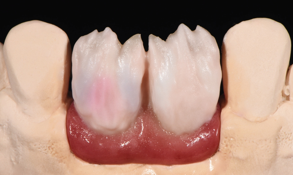 Abb. 3: Für die Gingiva-Imitation wurde IPS e.max ZirPress G4 verwendet. Die Grundopazität der Kronen konnte durch IPS e.max Ceram Deep Dentin A3 definiert werden. Anschließend wurden Schichten von (1) IPS e.max Ceram Dentin A3,5, (2) IPS e.max Ceram Power Dentin A3,5 und (3) IPS e.max Ceram Selection Light Absorber fog (LA fo) und Light Absorber taupe (LA ta) aufgetragen. So konnte ein wunderbarer Kontrast in der „elfenbeinfarbenen“ Schicht erstellt werden.