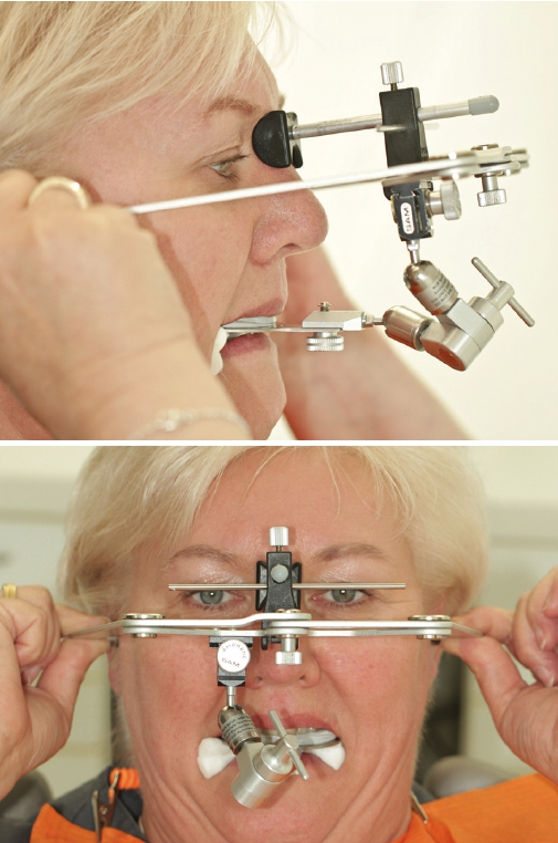 Abb. 3 u. 4: Angelegter Gesichtsbogen seitlich und frontal.