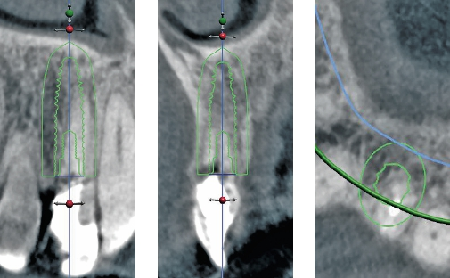 Abb. 3a-c: 3D-gestützte Planung der Implantatposition.