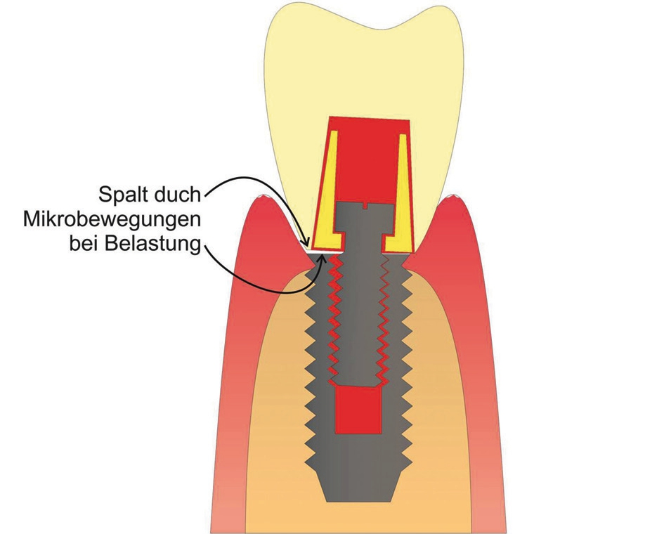 Abb. 3: Schematische Darstellung der Mikrobewegung unter Kaubelastung.