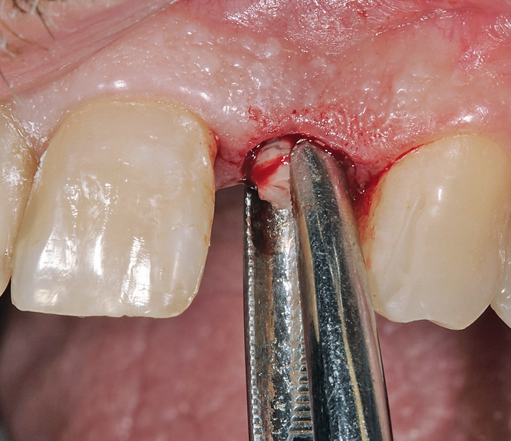 Abb. 3: Durch einen minimalinvasiven apikalen Zugang konnte der frakturierte Implantatrest entfernt werden. Nach der Lappenpräparation zeigte sich der ausgeprägte konkave Kieferkamm.