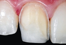 Abb. 3: Supragingivale Präparation. Der Schmelz wurde beidseitig interdental reduziert.
